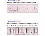 心律失常的类型有哪些？