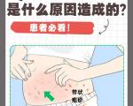 带状疱疹是什么原因造成的？