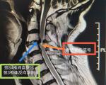 脊髓型颈椎病概述