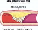 如何预防动脉斑块的形成？