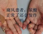 痛风发作，尿酸也可能正常
