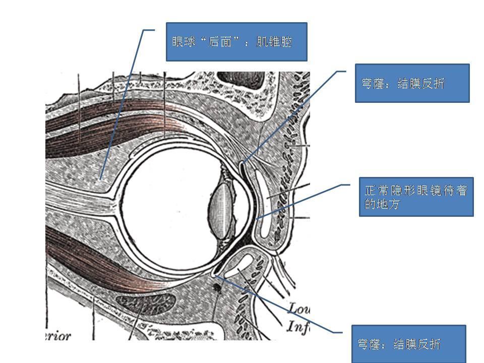 隐形眼镜有没有可能滑到眼球后面