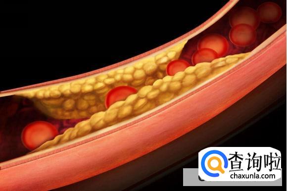 瘦人不会高血脂吗