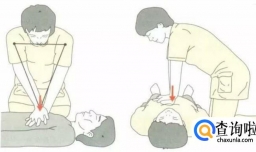 心脏骤停应该如何急救