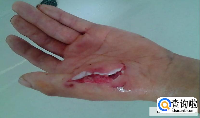 如何判断自己是否得了狂犬病