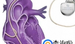 安装心脏起搏器有哪些优劣之处