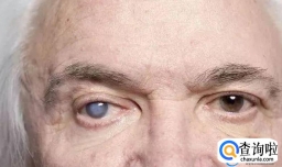 白内障有什么症状