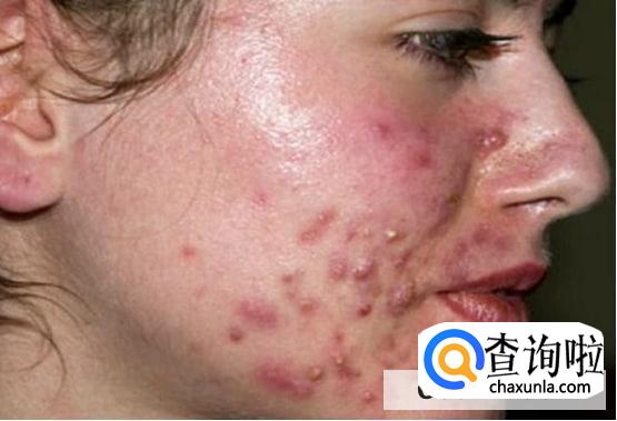 背部痤疮怎么办