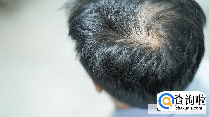 一挠头就掉头发怎么回事？