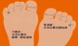 香港脚是什么意思