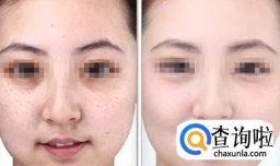 总是祛不了斑你知道是为什么吗？