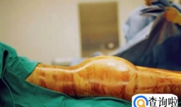 吸脂肪对身体有害吗