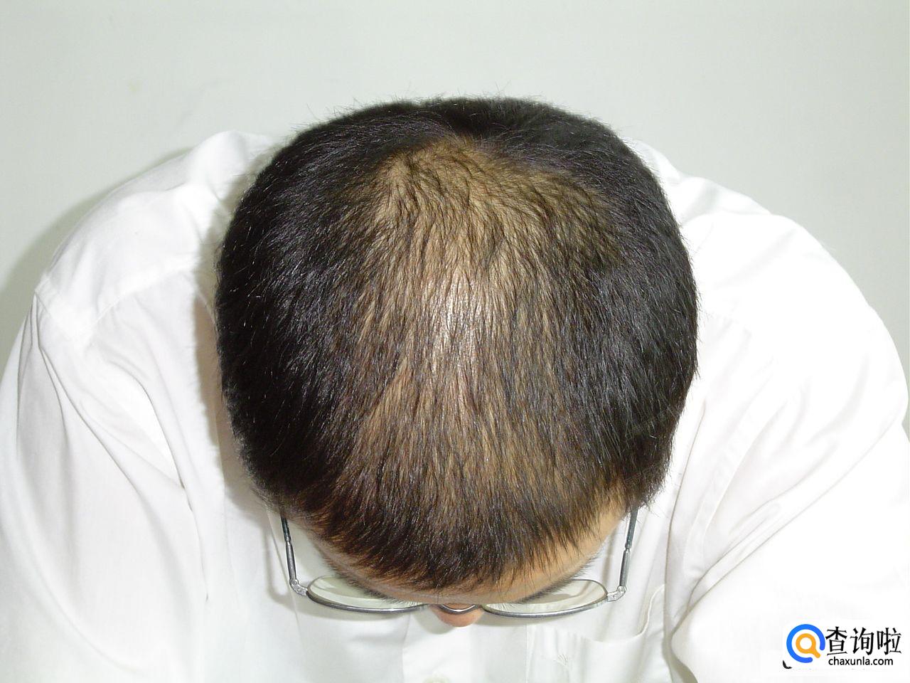 一挠头就掉头发怎么回事？