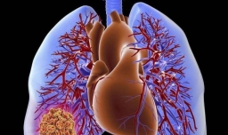 怎样预防肺栓塞