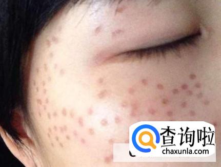 有哪些祛除雀斑的好方法