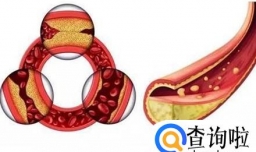 甘油三脂高怎么办