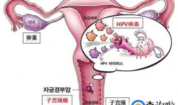 HPV和TCT有何区别