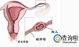 宫外孕早期症状