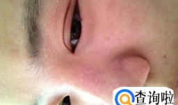 脸上起皮怎么办好