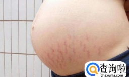 妊辰纹怎样祛除？妊娠纹能完全去除吗？