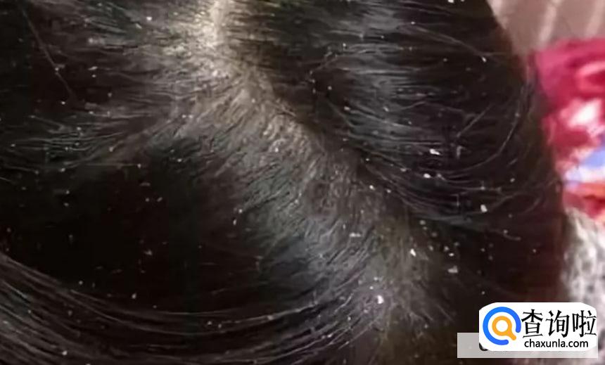 头皮痒越抓越痒怎么回事
