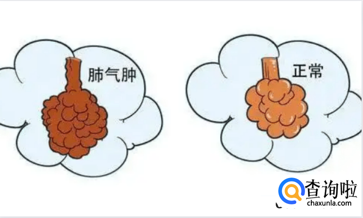 患有肺气肿的原因是什么