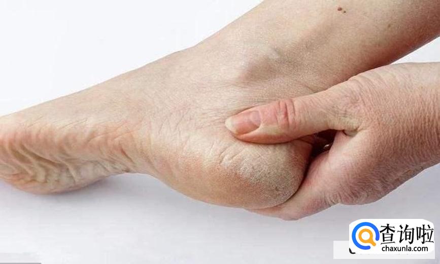 脚后跟干裂如何保养及护理