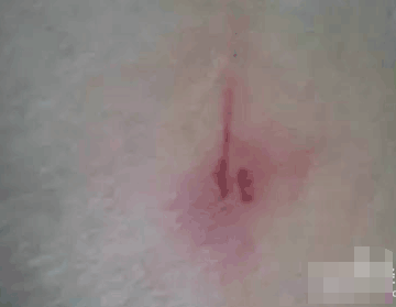 被虫子咬了怎么办