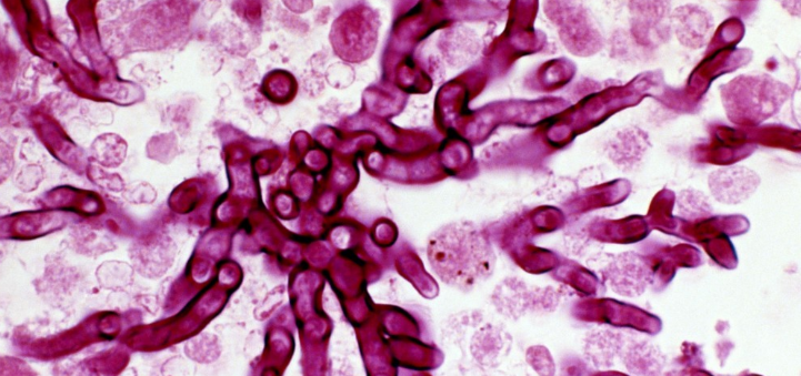 真菌感染怎么办