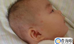 为什么宝宝会患有湿疹