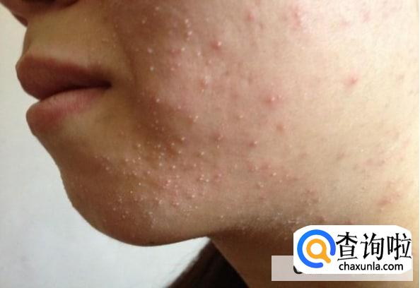 起粉刺为什么有白头