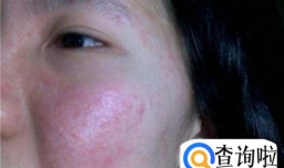 什么是红皮病 红皮病的病因有哪些