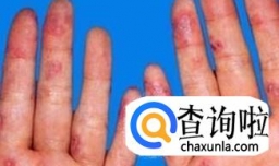 什么是红斑狼疮？怎样防治红斑狼疮？