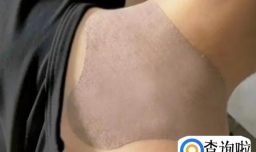 富贵包是什么原因引起的（长时间保持一个姿势）