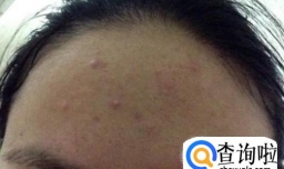 额头长痘怎么办