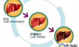 肝硬化如何定义 肝硬化的症状有哪些