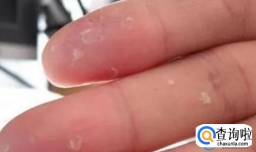 手蜕皮还痒的原因