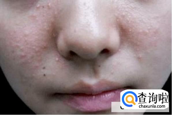 起粉刺为什么有白头