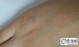 被两个月的小奶猫抓破皮了要打针吗