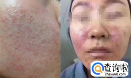 长期涂抹激素类药物的危害