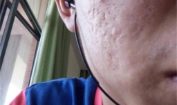 芦荟胶能去痘坑痘印吗 芦荟胶怎么用才正确方法