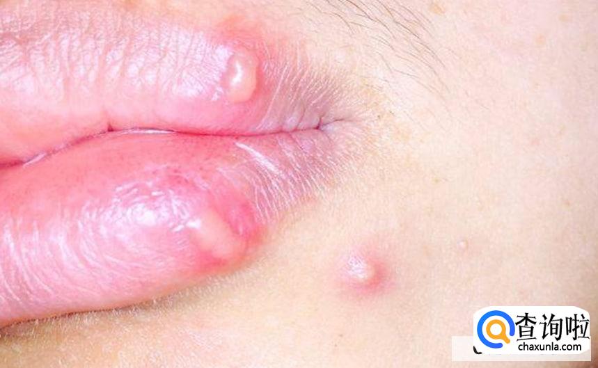 嘴上疱疹有脓能挤么