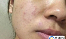 反复长痘是怎么回事？