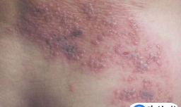 带状疱疹和皮炎你真的知道它们的区别吗