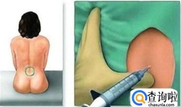 无痛分娩的性价比高吗？