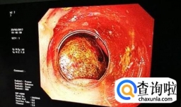 什么情况下需要做胃镜检查