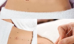 埋线减肥的优缺点