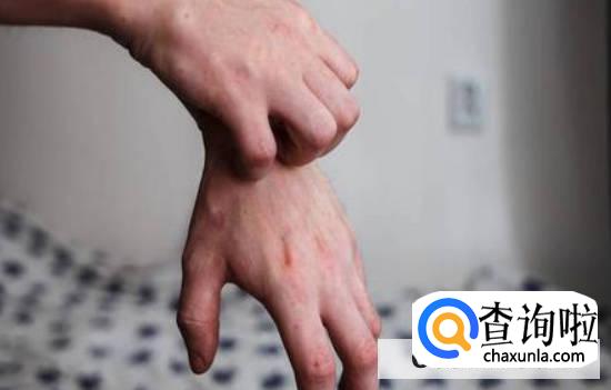 毛囊炎产生的原因是什么