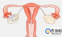 为何会患有多卵巢综合症