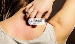 背部有痤疮会痒吗